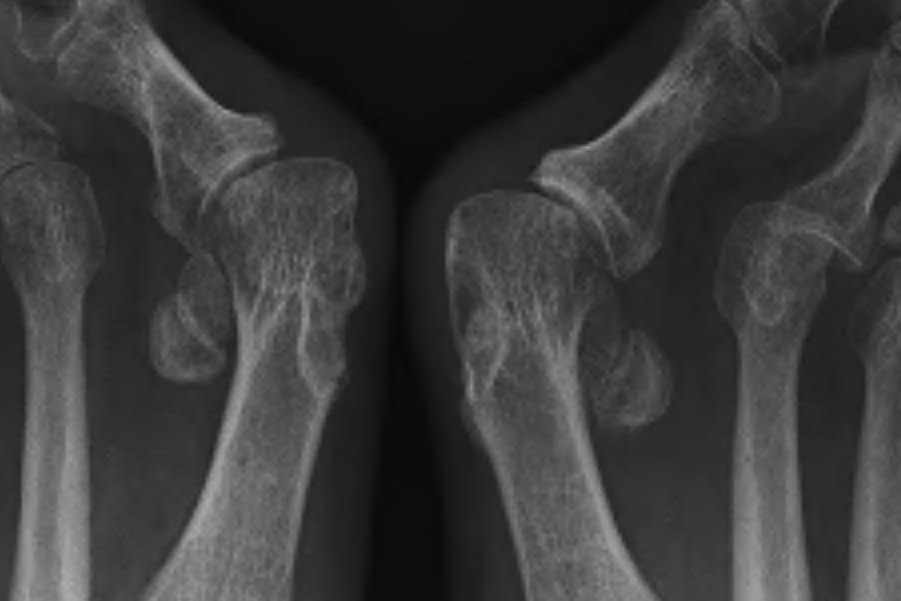 Hallux Valgus Lateral Sesamoid Uncovered